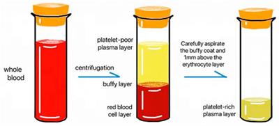 Efficacy analysis of splint combined with platelet-rich plasma in the treatment of temporomandibular joint osteoarthritis